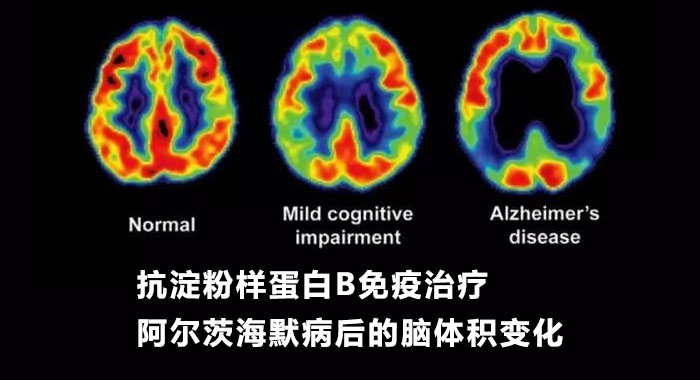 抗淀粉样蛋白&beta;免疫治疗阿尔茨海默病后的脑体积变化：淀粉样蛋白去除相关的假性萎缩（英文）