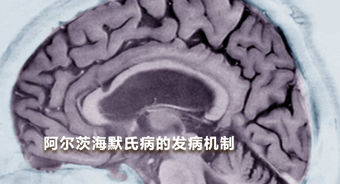 阿尔茨海默氏病的发病机制（英文）